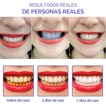 Smile kit - Dentes blancos T